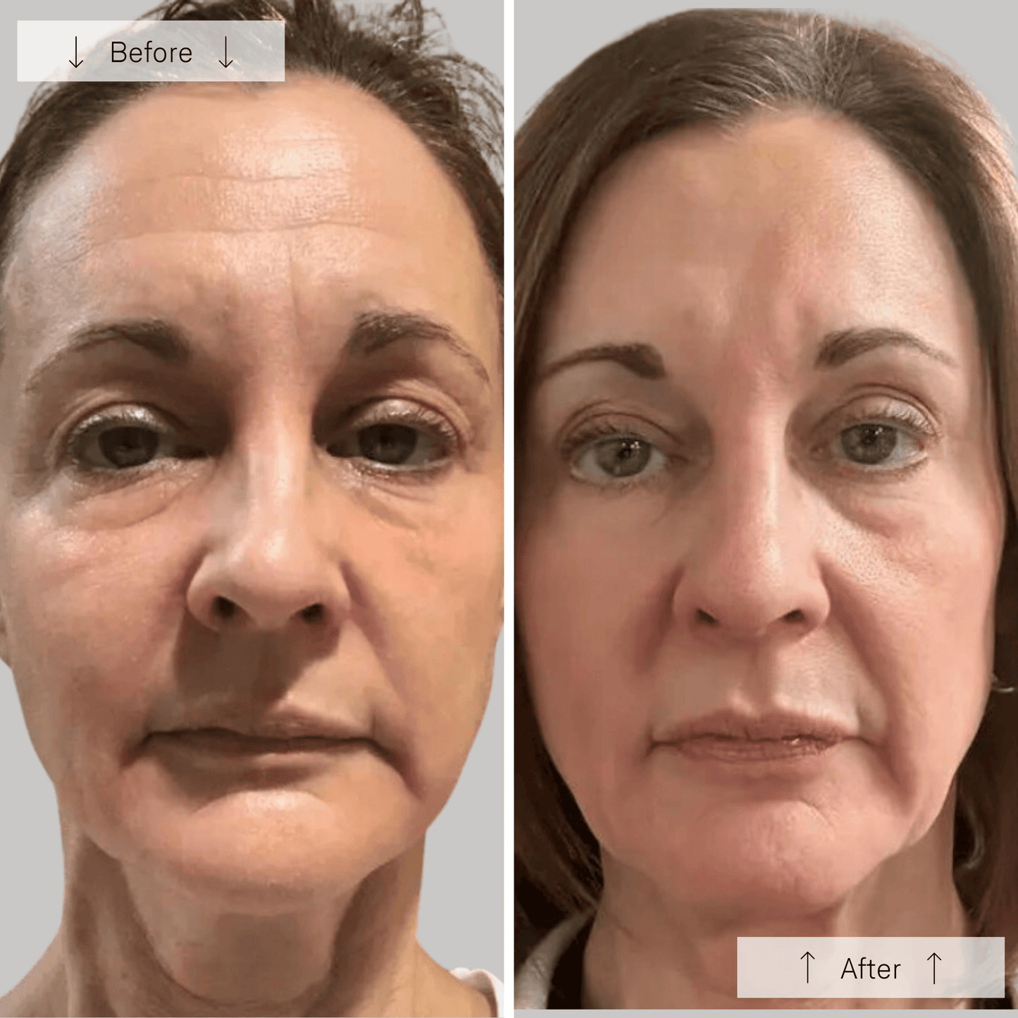 Lumea Contour Face